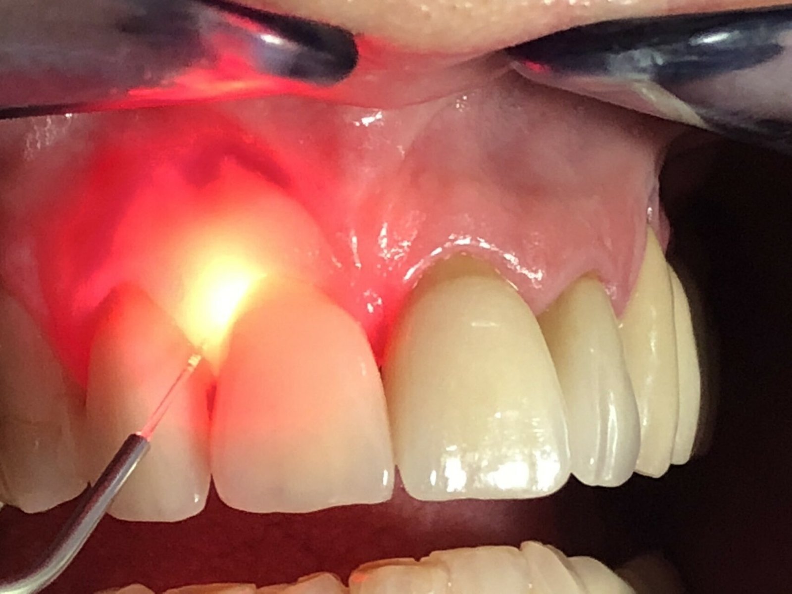 Gums Depigmentation
